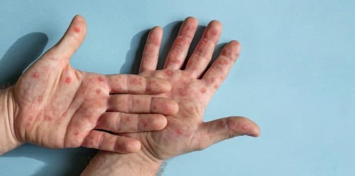 88_kasus_mpox_terkonfirmasi_di_indonesia