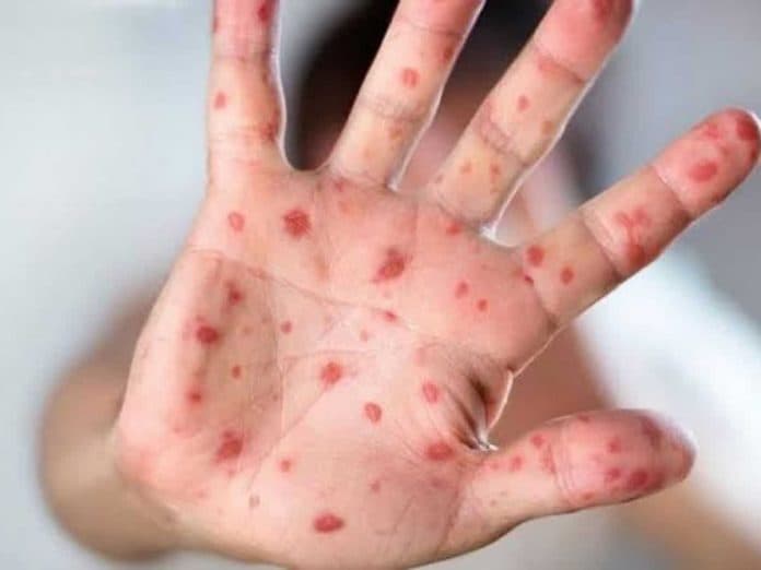 mpox_di_jakarta_sudah_mencapai_59_kasus