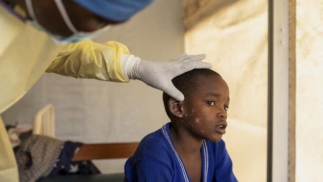 mpox_varian_baru_terdeteksi_di_india