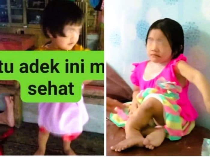 dinkes_sumut_sebut_kaki_anak_perempuan_di_nisel_bengkok_bawaan_lahir_tetangga_nn_membantah_