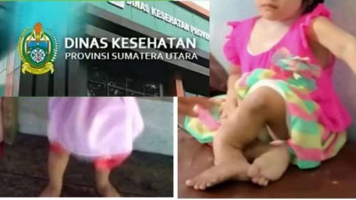 dinkes_sumut_tanggapi_bantahan_tetangga_nn_terkait_kaki_yang_diderita_bawaan_lahir