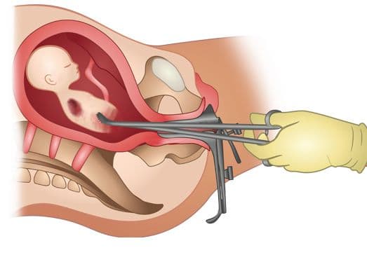 kades_di_dairi_diduga_suruh_wanita_simpanannya_aborsi