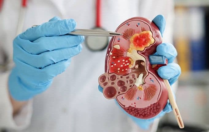 waspada_dokter_ungkap_penyebab_awal_penyakit_ginjal_kronis_dan_faktor_pemicunya