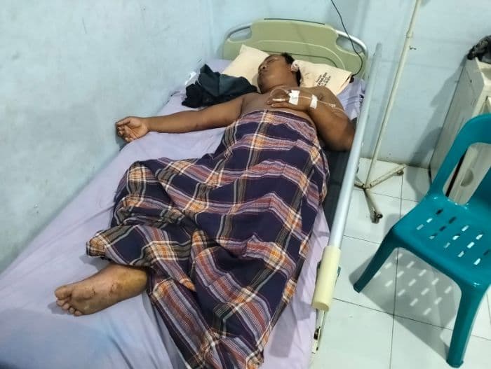 korban_selamat_kecelakaan_bus_halmahera_jalani_operasi_wajah_di_lubuk_pakam