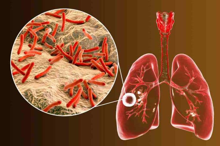 kasus_tuberkulosis_tembus_70_ribu_di_medan