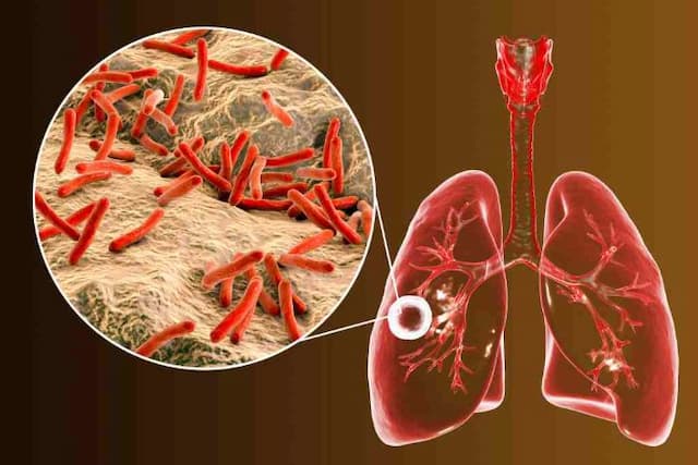 kasus_tuberkulosis_tembus_70_ribu_di_medan