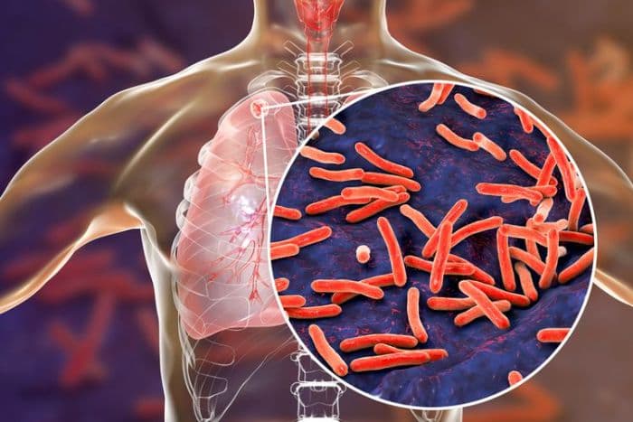 kasus_tuberkulosis_di_simalungun_capai_ribuan_dinkes_beberkan_penanggulangan_yang_dilakukan