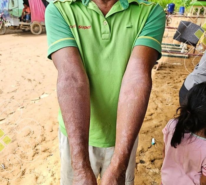 penjelasan_dokter_spesialis_kulit_tentang_gatalgatal_setelah_terkena_air_banjir