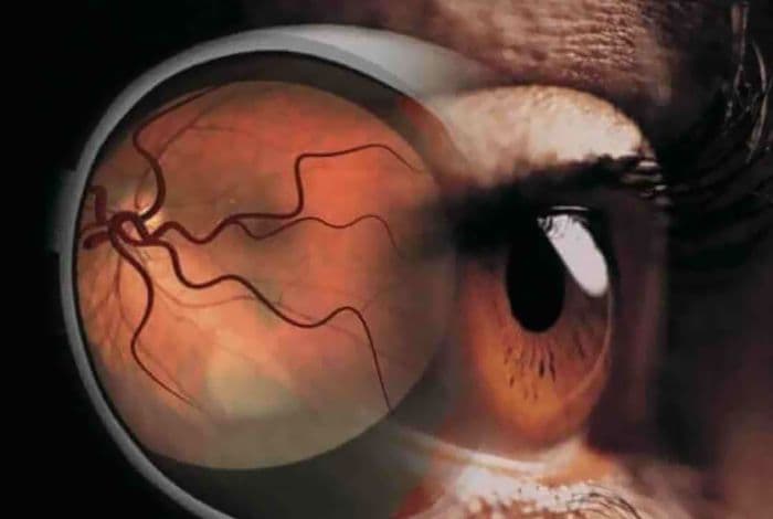 mengenal_retinopati_diabetik_komplikasi_diabetes_paling_berbahaya