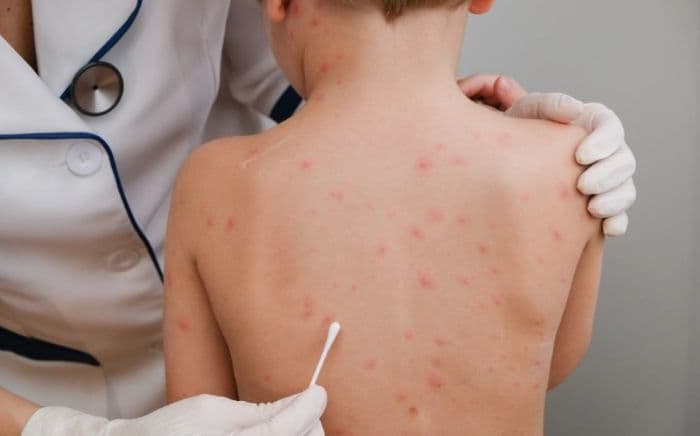 gejala_campak_pada_anak_kenali_tahapan_awal_hingga_ruam_khas_menurut_dokter