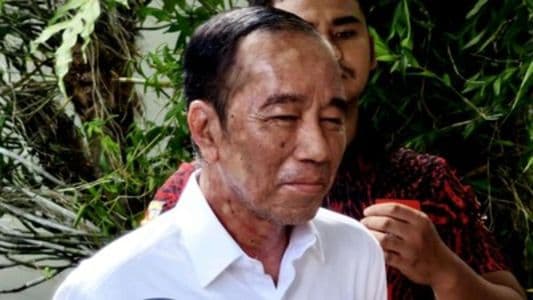 mengenal_sindrom_sjs_penyakit_langka_yang_diduga_diderita_jokowi