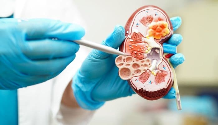 dokter_ungkap_alasan_penyakit_ginjal_baru_disadari_saat_sudah_parah