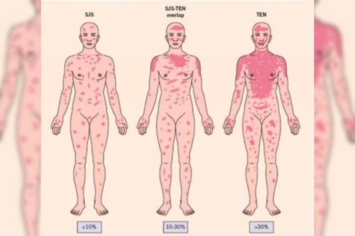 dokter_penyakit_sjs_bisa_sebabkan_kematian_dan_komplikasi_serius