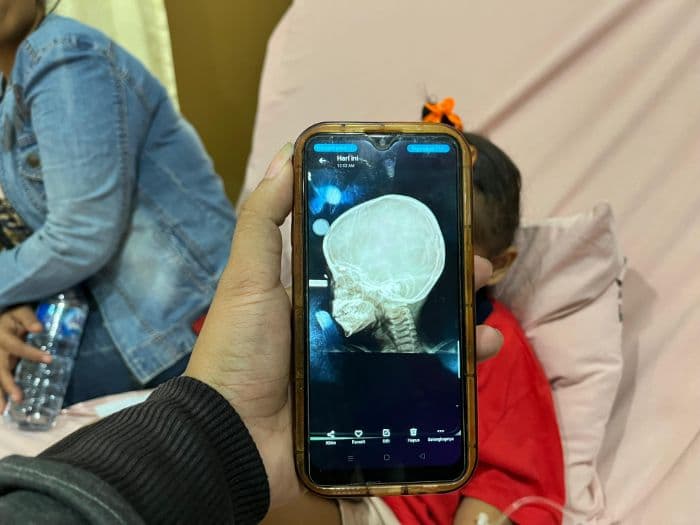 balita_korban_peluru_nyasar_kian_membaik_besok_dijadwalkan_lepas_jahitan_operasi