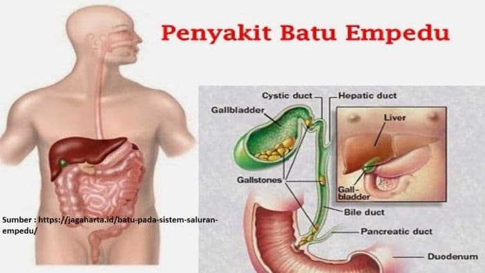 enam_makanan_ini_terbukti_bantu_larutkan_batu_empedu_secara_alami