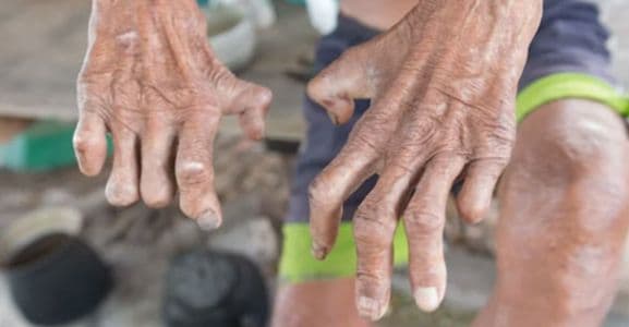 daftar_wilayah_kasus_kusta_yang_masih_tinggi_di_indonesia