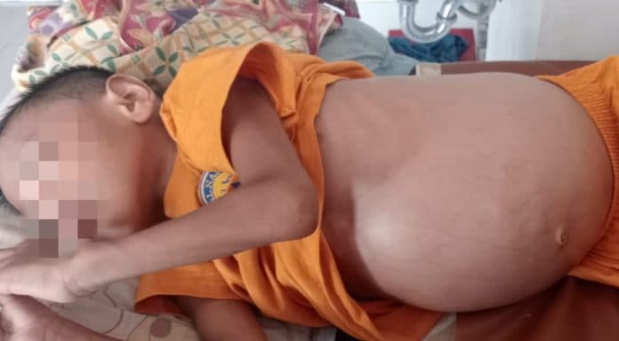 anak_penderita_tumor_ganas_di_simalungun_butuh_uluran_tangan