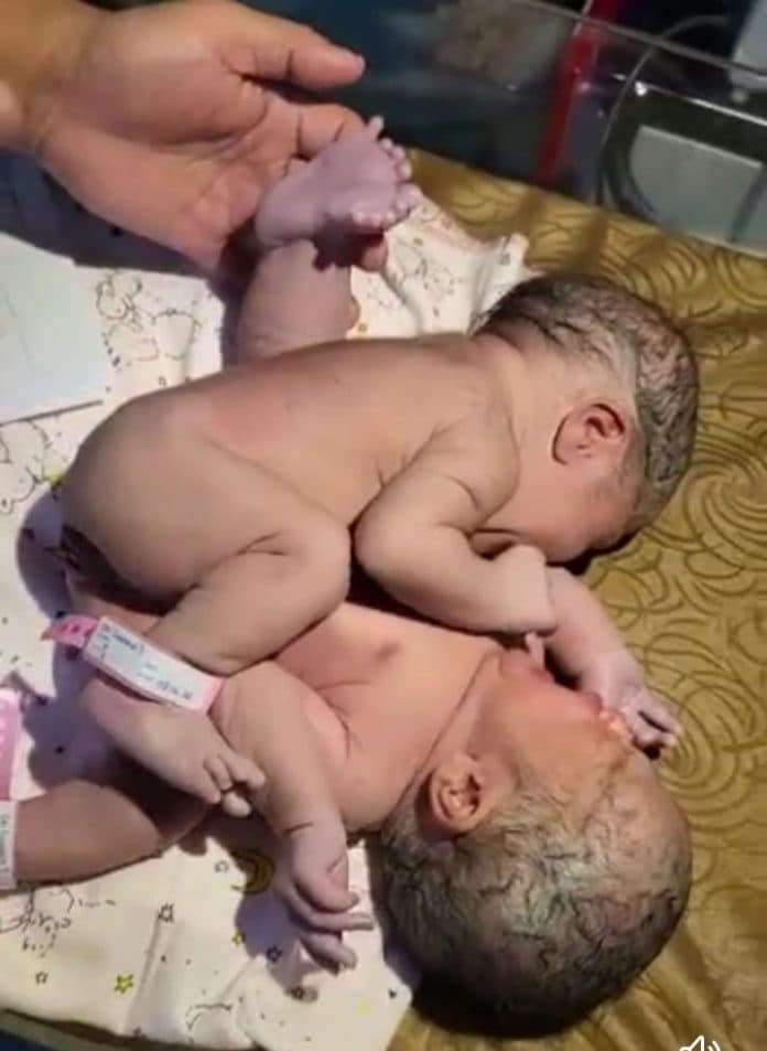 bayi_kembar_siam_dengan_tiga_kaki_dan_perut_menyatu_lahir_di_asahan