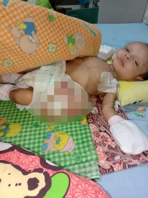 bayi_yang_terlahir_tanpa_anus_itu_akhirnya_berpulang