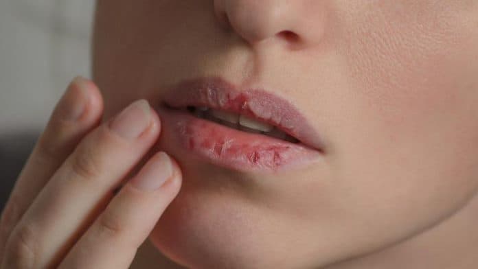 bibir_pecah_pecah_bisa_sebabkan_infeksi_bakteri_kenali_penyebabnya