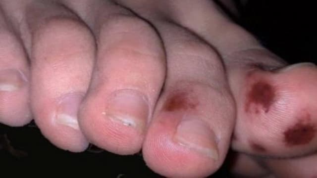 gejala_corona_bisa_dilihat_dari_kaki