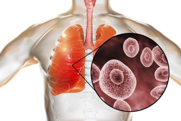 indonesia_tidak_punya_reagen_khusus_pneumonia