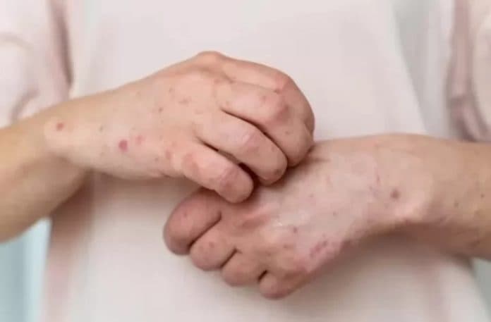 kemenkes_dapati_116_suspek_mpox_hanya_hasilnya_negatif