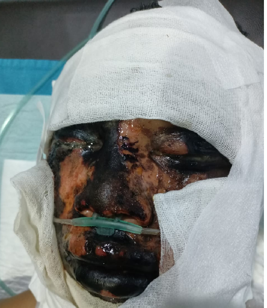 pelaku_penyiraman_air_keras_di_percut_sei_tuan_masih_berkeliaran