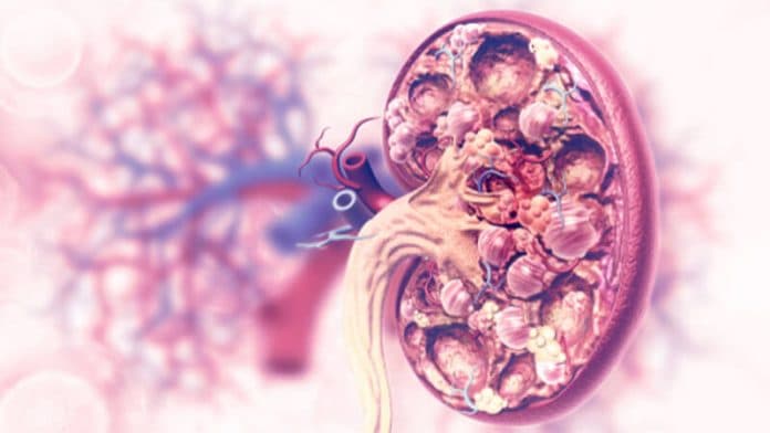 penyebab_pasti_lupus_nefritis_belum_diketahui