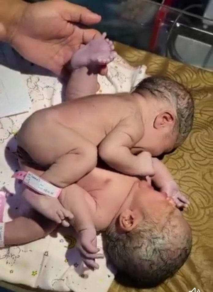 Bayi Kembar Siam dari Asahan Akhirnya Dirujuk ke RS Adam Malik